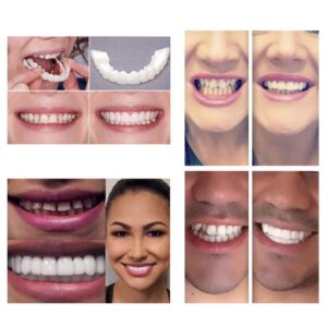 Perfect Smile Snap On Braces