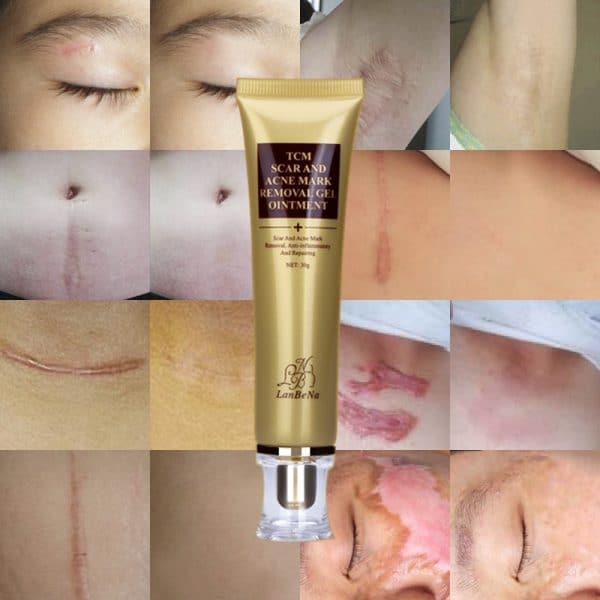 Acne Scar Remover Cream - Image 5