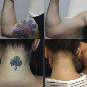 Permanent Tattoo Removal Cream