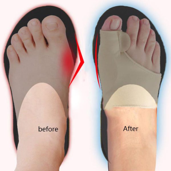 Orthopedic Bunion Corrector