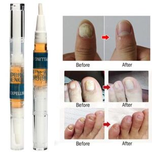 Onychomcycosis Repair Pen