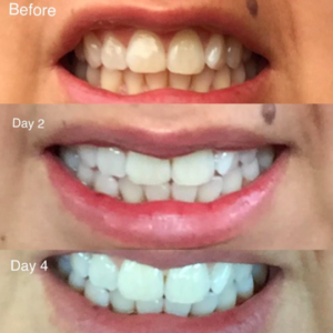 Magical Teeth Whitening Powder