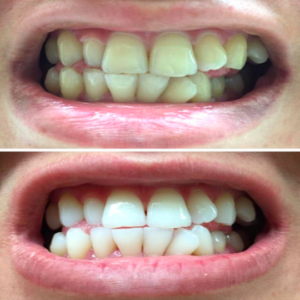 Magical Teeth Whitening Powder