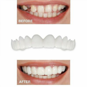 🔥50% OFF🔥 Magic Smile Teeth Brace 💝BUY 1 GET 1 FREE!