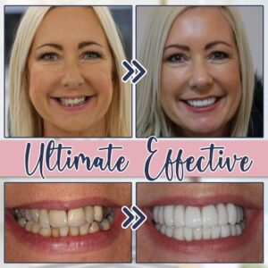 StainGone™ Teeth Whitening Toothpaste