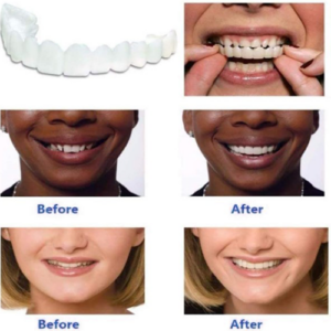 🔥50% OFF🔥 Magic Smile Teeth Brace 💝BUY 1 GET 1 FREE!