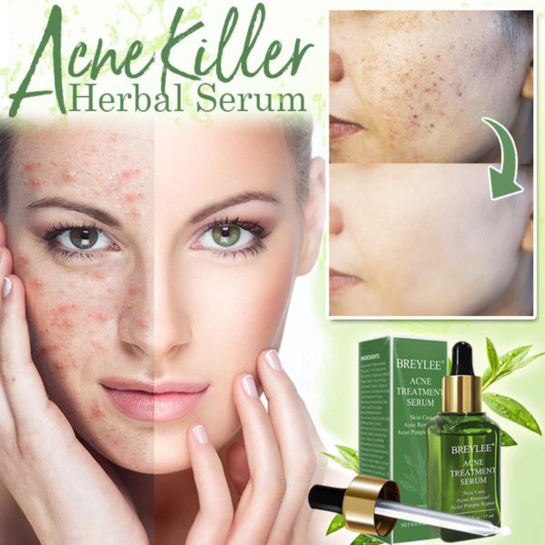 AcneAway Herbal Serum