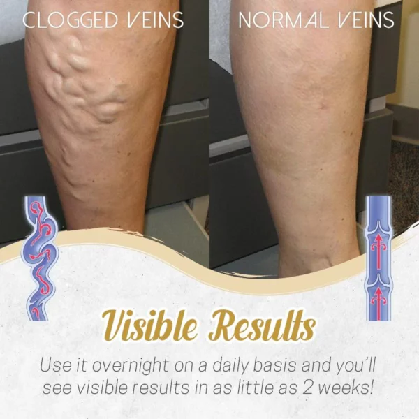 Herbal Detox Patch for Varicose Veins