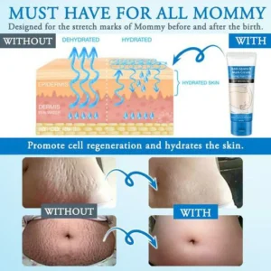 Striae Off™ Anti-Stretch Mark Cream