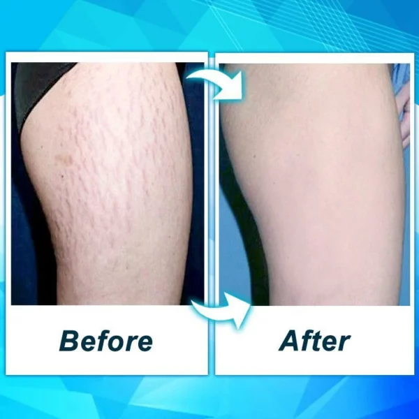 Dr. Removal™ Stretch Mark Firming Cream