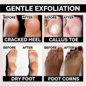 Anti-Fungal Peeling Foot Soak