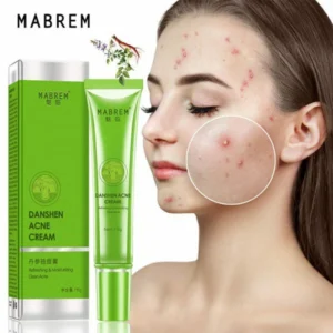 Acne Removal Cream Treatment