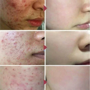 Acne Removal Cream Treatment