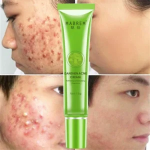 Acne Removal Cream Treatment