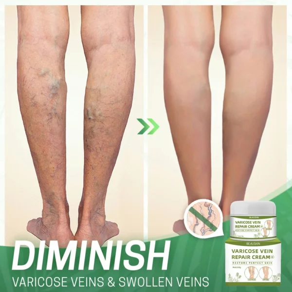 BeauSkin™ Spider Veins Repair Cream