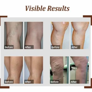 LegVeins OrganicPatch