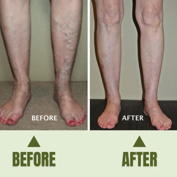 Varicose Veins Healing Cream