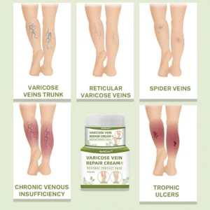 Varicose Veins Healing Cream