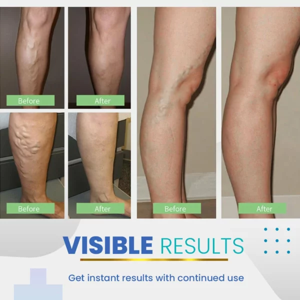 BeauSkin Spider Veins Repair Cream