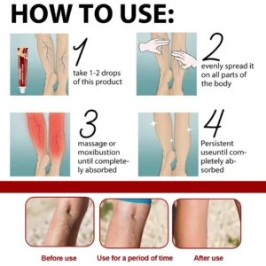 Varicose Veins Relief Cream