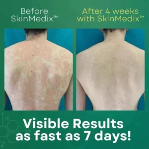 SKINMEDIX™PSORIASIS CREAM