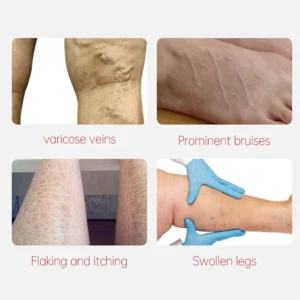 AUQUEST™ Varicose Veins Relief Cream