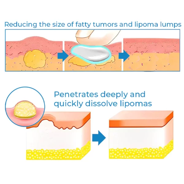 CurSkin™ Lipoma Treatment Ointment