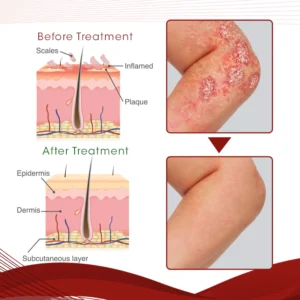 DermaCure Psoriasis Treatment Spray