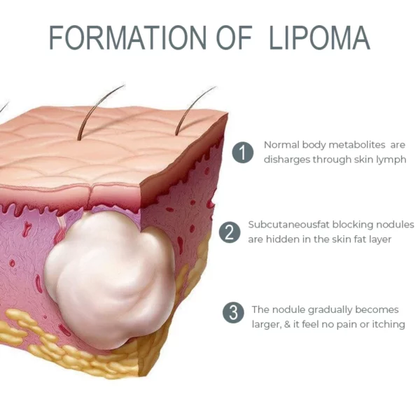 LUMPFree Herbal LipomaRemoval Cream