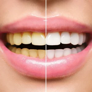 Lanthome™ Teeth Whitening Mousse