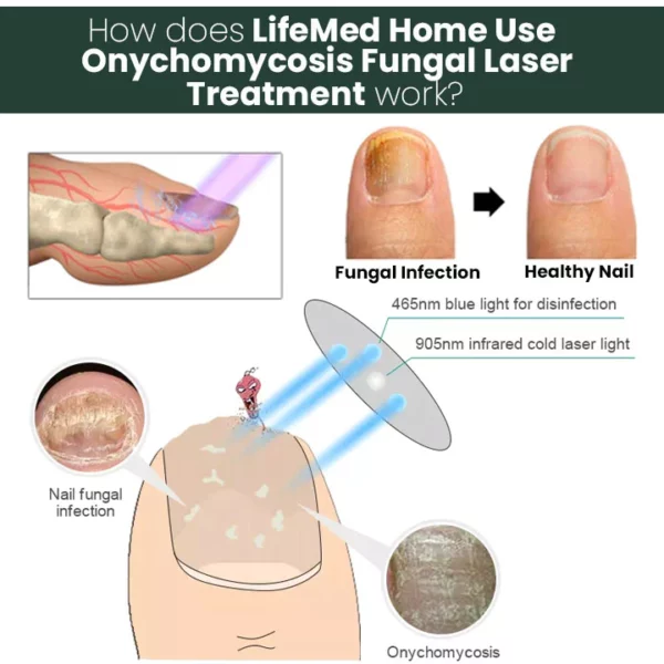 LifeMed Home Use Onychomycosis Fungal Laser Treatment