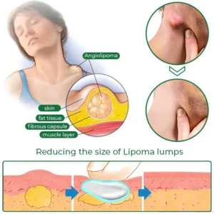 LipomaCure™ Soothing Ointment