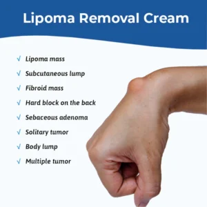 MEDix™ Lipoma Removal Cream