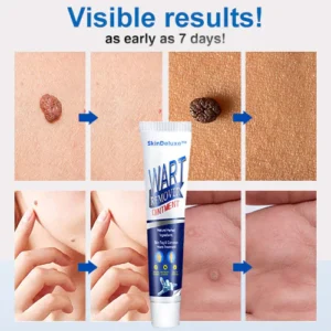 SkinDeluxe™ Wart-Removal Ointment