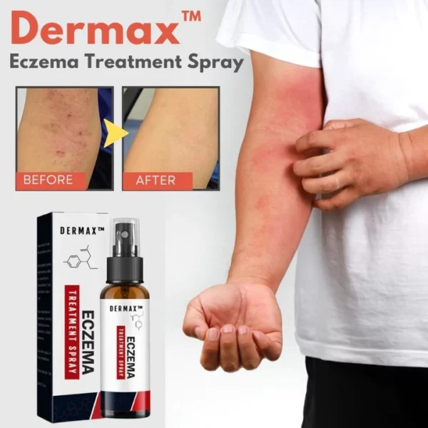 Dermax™ Eczema Treatment Spray