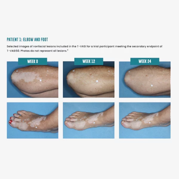 MEDix™ Vitiligo Relief Spray