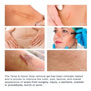 Medical Grade Silicone Scar Gel