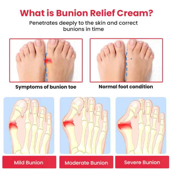 Medifix Bunions Relief Cream