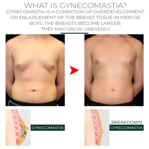 MensGynecomastia ReductionHerbal Ointment