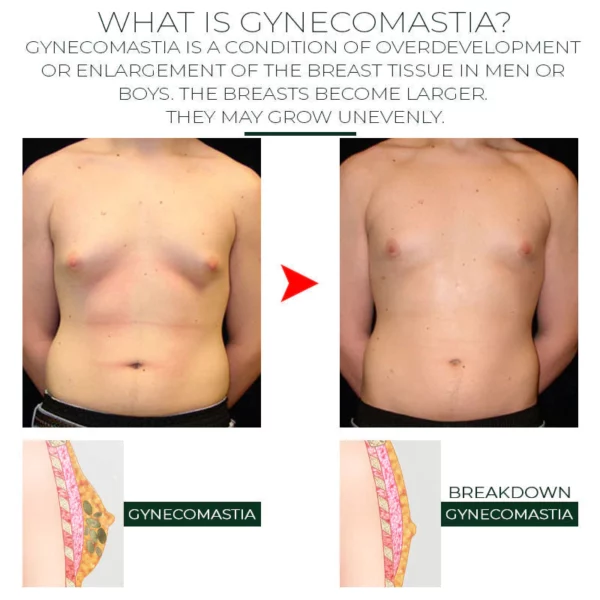 MensGynecomastia ReductionHerbal Ointment