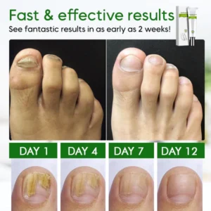 NailCare™ Toe Nail Treatment Gel