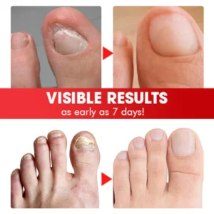 Nailcare™ Ingrown Toe Nail Drops