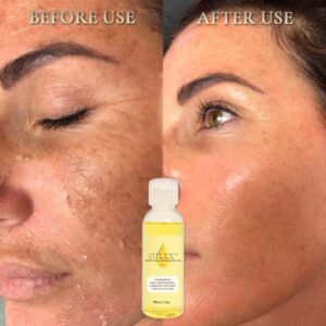 Oilex™ Natural Spots Whitening Yellow Peeling Oil