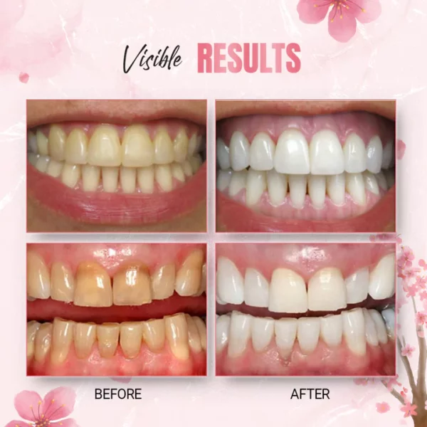 WhiteLab™ Teeth Stain Removal Whitening Strips