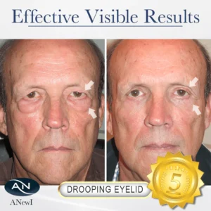 ANewI™ Pro Eye-Lift Depuffing Gel