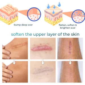 Bioskin™ Advanced Scar Removal Gel