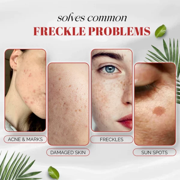 Effective Whitening Freckle Cream