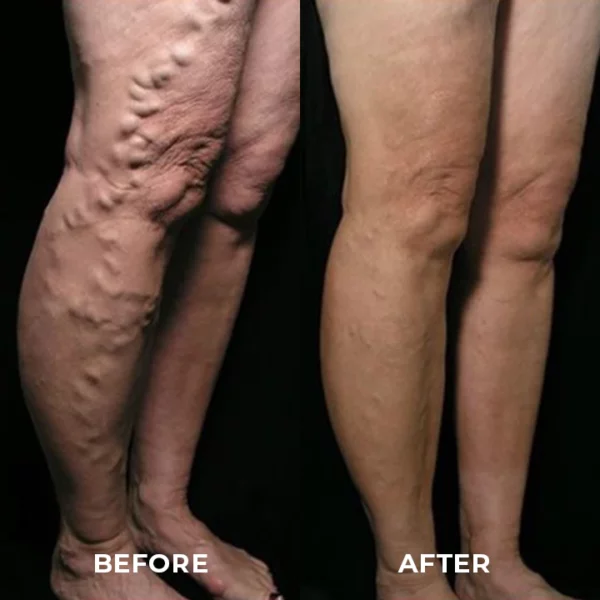 MEDix™ Varicose Veins Spray