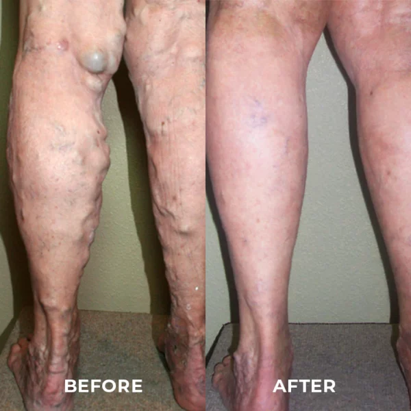 MEDix™ Varicose Veins Spray - Image 7