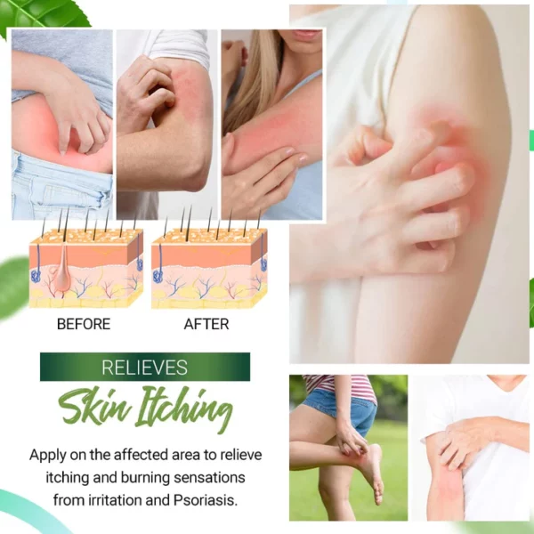 Psoriasis Relieving Cream